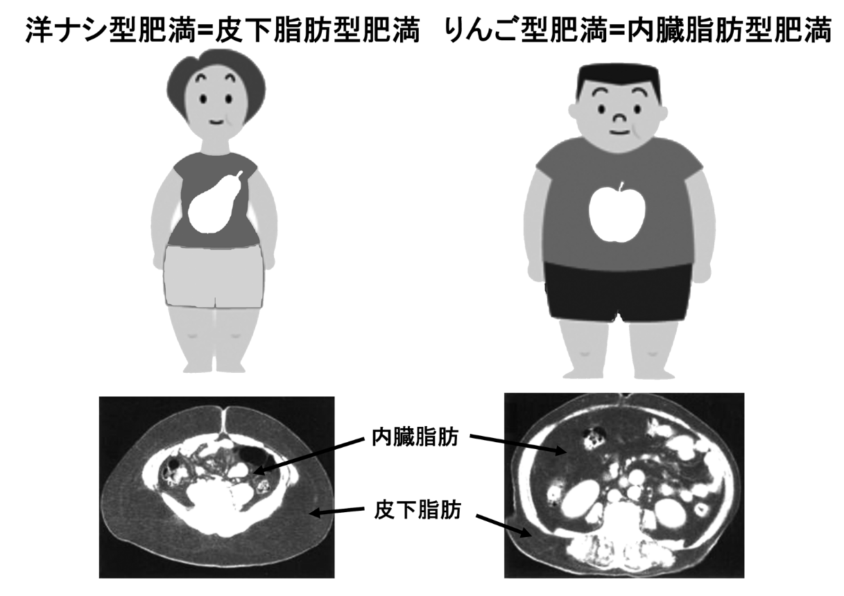 皮下脂肪型肥満と内臓脂肪型肥満
